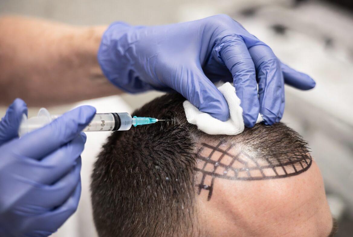 PRP Hair Restoration In San Marcos- Results And Timeline (1)
