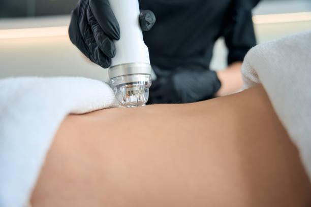 Does RF Microneedling Cause Fat Loss