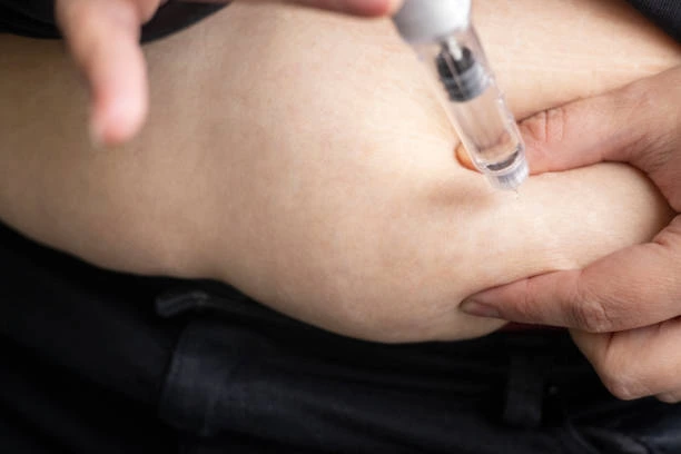 glp 1 subcutaneous injection What Are the Recommended GLP-1 Injection Sites?