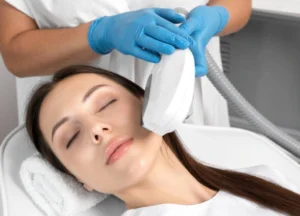 IPL Photofacial Treatments San Marcos
