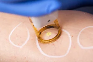 Laser Spider Vein Removal in San Marcos