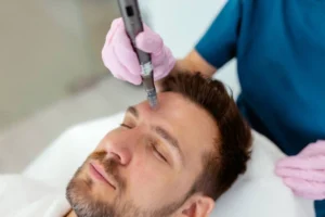 Microneedling San Marcos