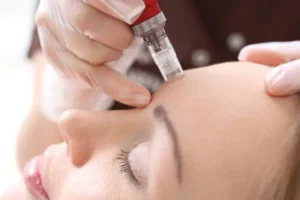 Microneedling Summerlin
