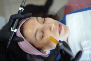 Microneedling with PRP Costa Mesa