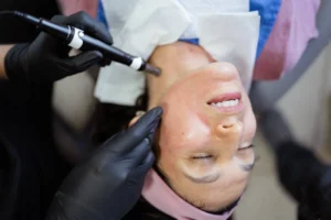 PRP with Microneedling San Marcos