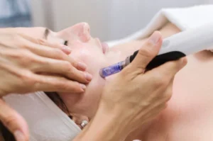 RF Microneedling San Marcos