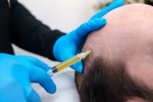 prp hair restoration san marcos