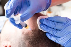 PRP Hair Restoration