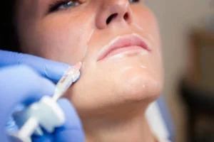 Juvederm Costa Mesa