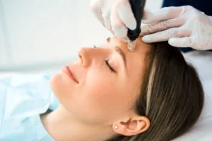 How Many Microneedling Sessions For Acne Scars