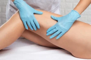 Laser Spider Vein Removal Costa Mesa