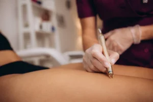 Laser Spider Vein Removal Newport Beach